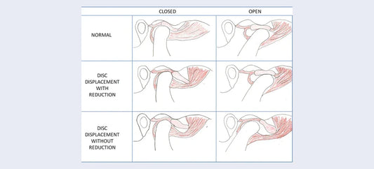 TMJ disc displacement diagram closed and open mouth positions